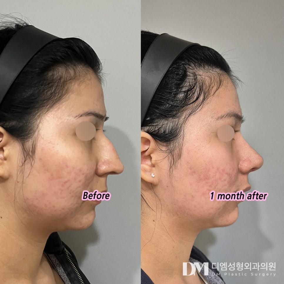 Could I also be the type of person who needs correction for an arrow nose? image 6