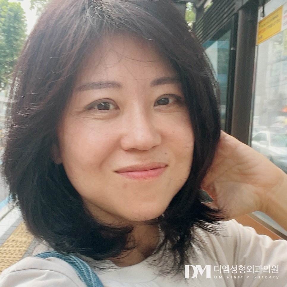 Facelift: What If Deep-Set Wrinkles Are Really Bothering You? image 1