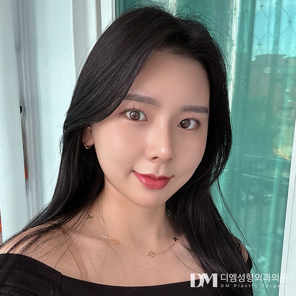 긴코성형, 짧은 중안부로 동안 되기 관련 이미지 1
