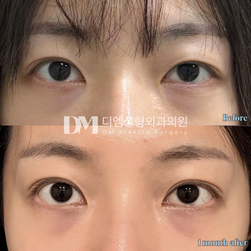 Revision Eyelid Surgery Review. "It turned out just as I expected, so I’m very satisfied!" image 2