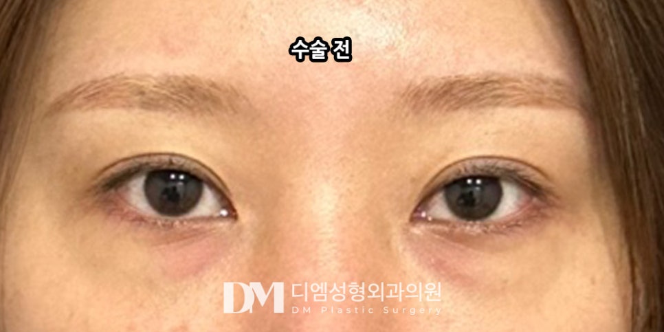 Lateral and Lower Canthoplasty for Softer, Gentler-Looking Eyes?! image 5