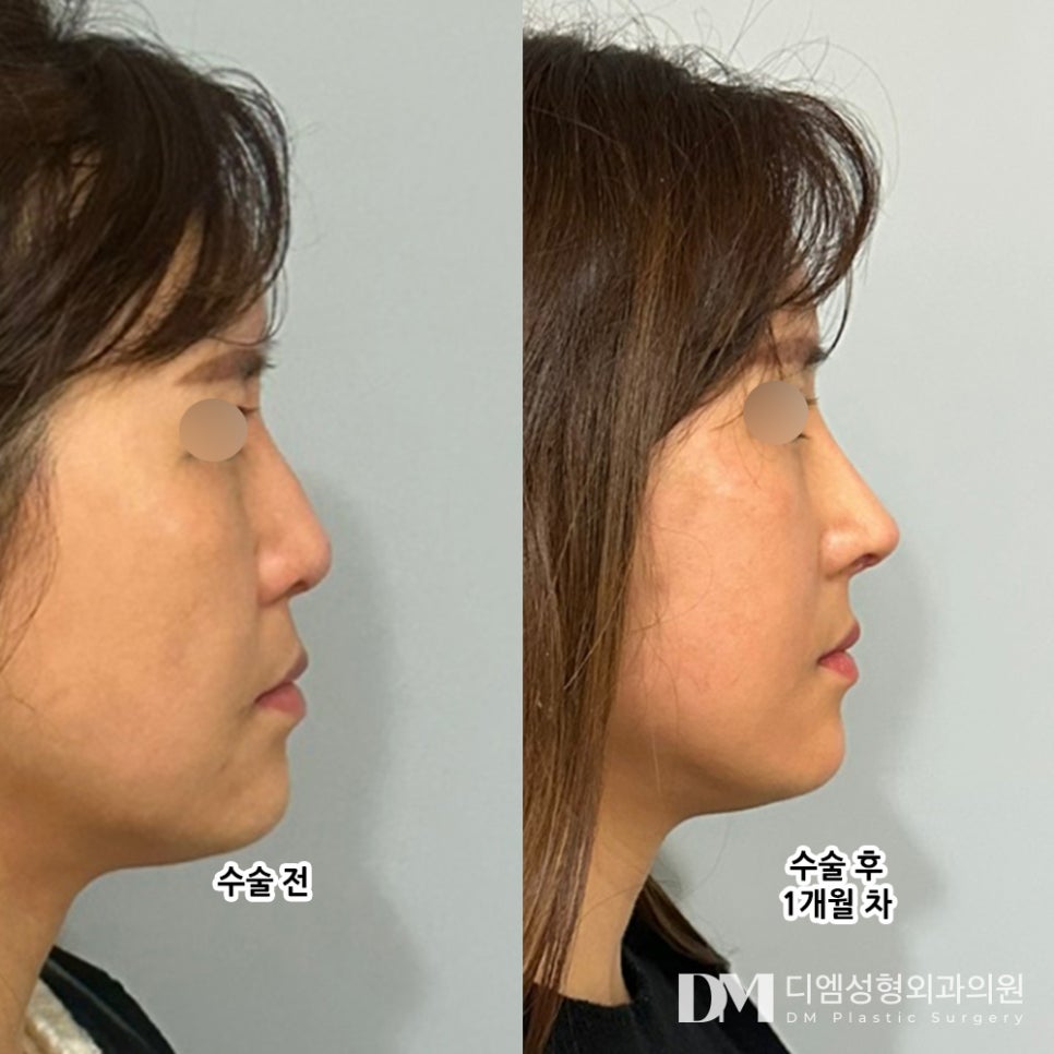 Hump Nose Surgery, From Functional Discomfort to Aesthetic Beauty! image 6