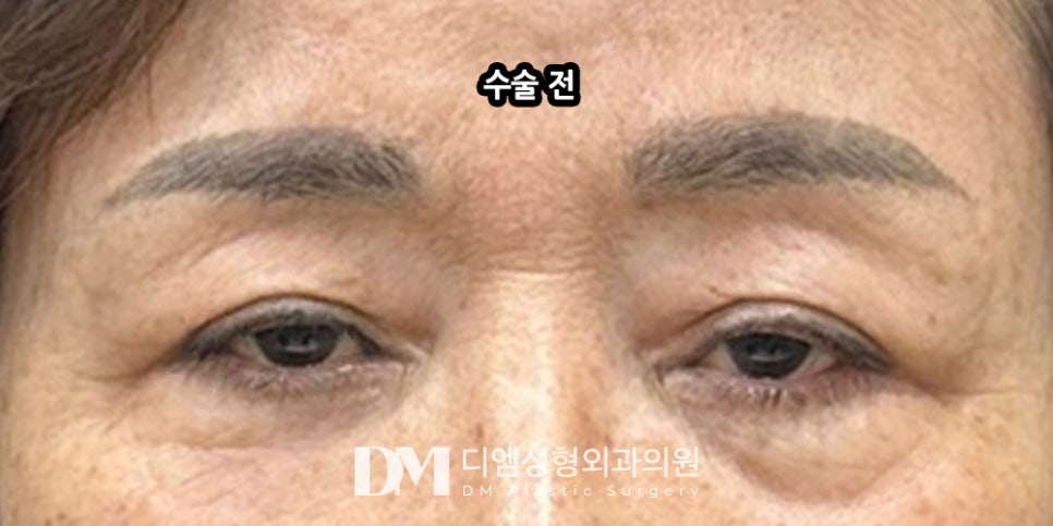 상안검, 처진 눈매 개선을 위한 중년 눈성형 관련 이미지 10