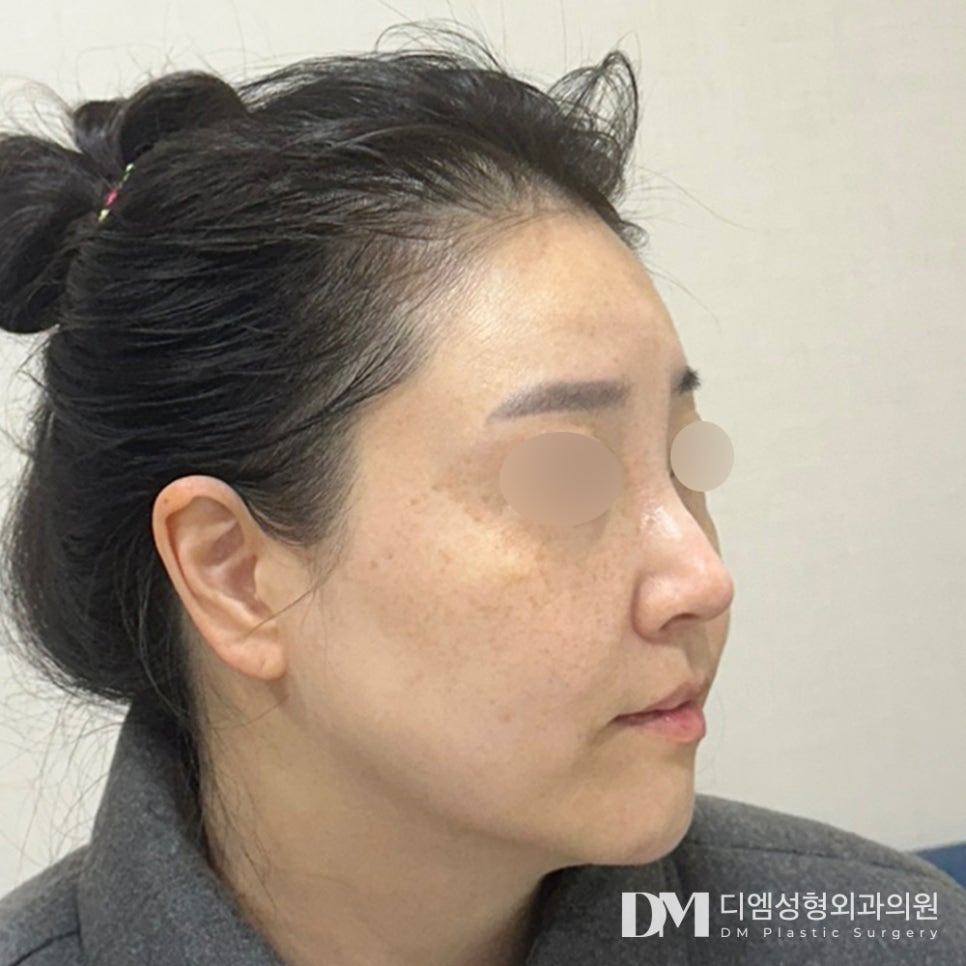 냉동지방이 아닌 생생 지방으로 ! 디엠 얼굴지방이식 관련 이미지 6