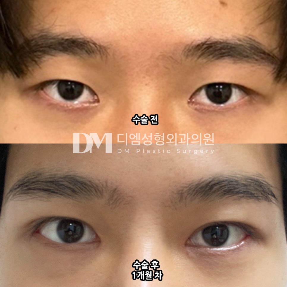 Eye Plastic Surgery Review: “I’m so, so satisfied because it looks natural, as if these had always been my eyes!” image 2