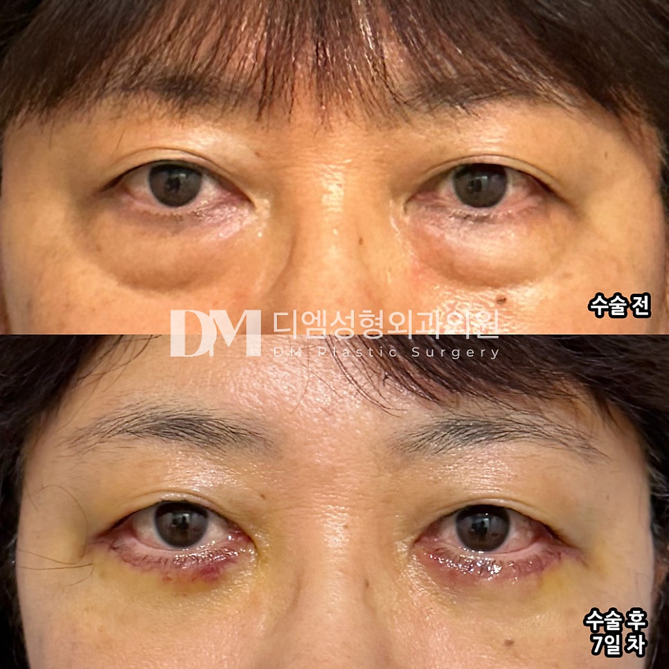 하안검 후기."실밥 풀고 나서는 일상 생활이 가능할 정도로 회복도 빠르고 결과도 만족해요 !" 관련 이미지 2