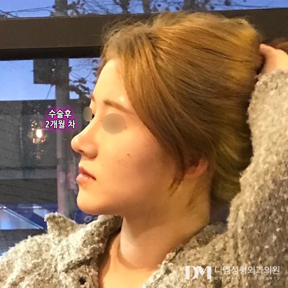 Tip Rhinoplasty: What If the Tip of Your Nose Looks Bulbous? image 9