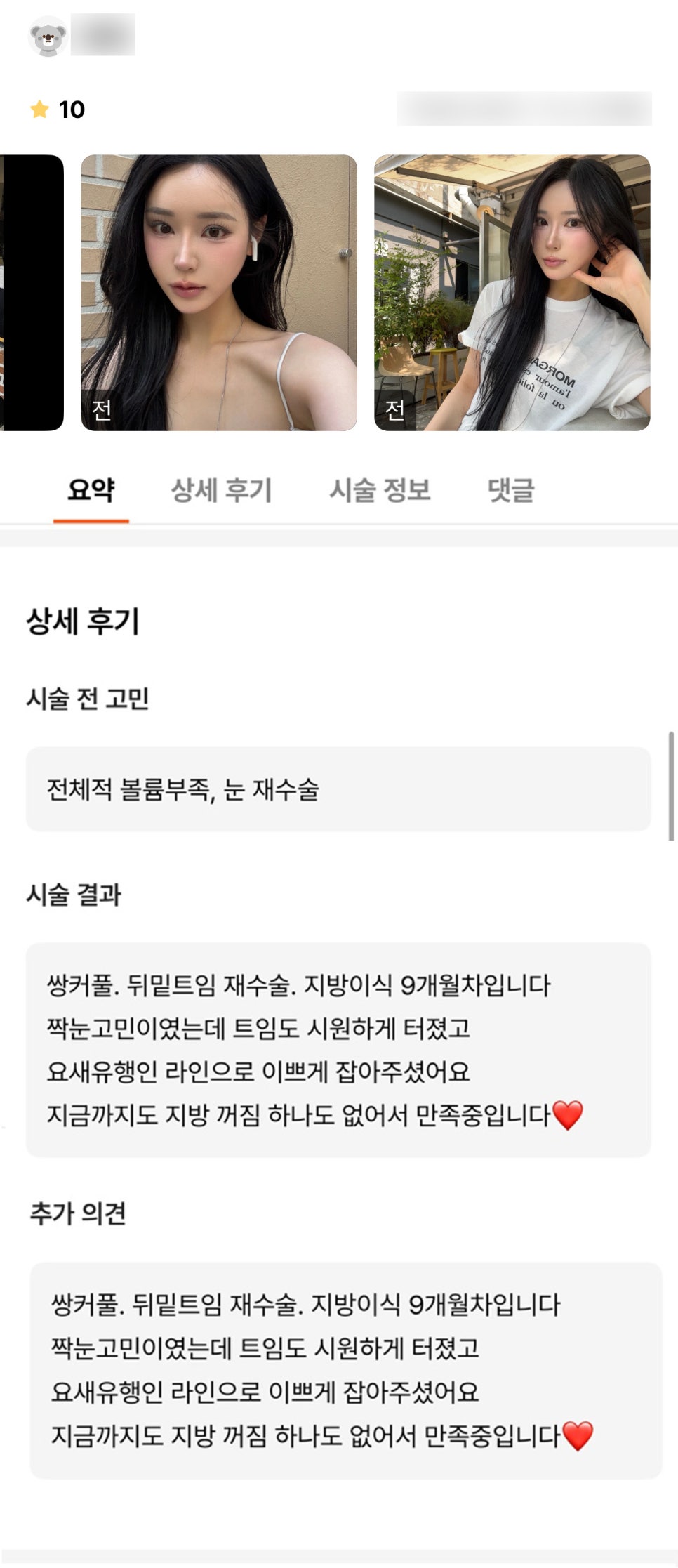 Plastic Surgery Review. "I’m satisfied that the double eyelid line is trendy these days and that there is no loss of fat even after 9 months!" image 1