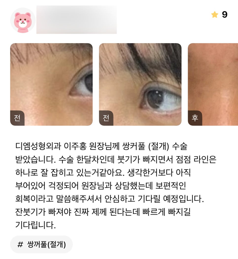 Eye Surgery Review: “It’s only been a month, but I think the crease is taking shape nicely!” image 1