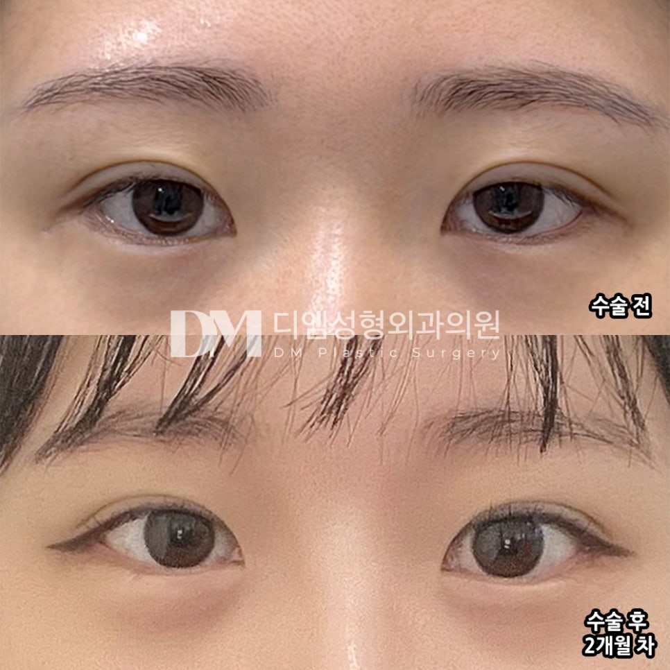 디엠 트임재수술 후기, &ldquo;알게 모르게 시원하게 트여서 눈매가 예뻐요!&rdquo; 관련 이미지 2
