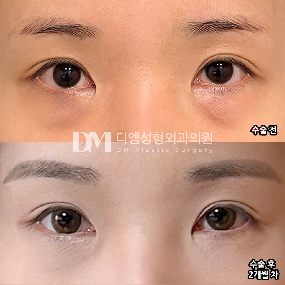 DM Under-Eye Fat Repositioning Surgery Review, “I’m Satisfied Because My Overall Appearance Looks Clearer!” image 2
