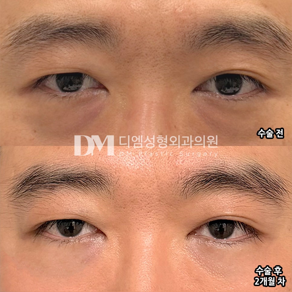 DM Under-Eye Fat Repositioning Surgery Review, “The fast recovery period makes daily life possible, so it’s not burdensome!” image 2