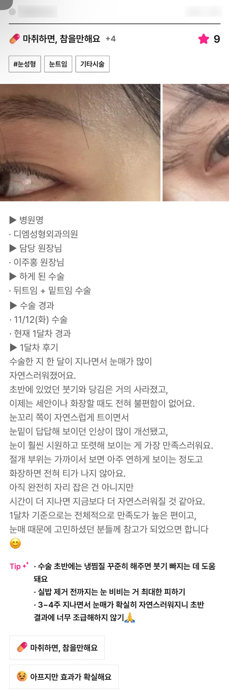 뒤밑트임 후기."눈이 훨씬 시원하고 또렷해 보이는게 가장 만족스러워요!" 관련 이미지 1