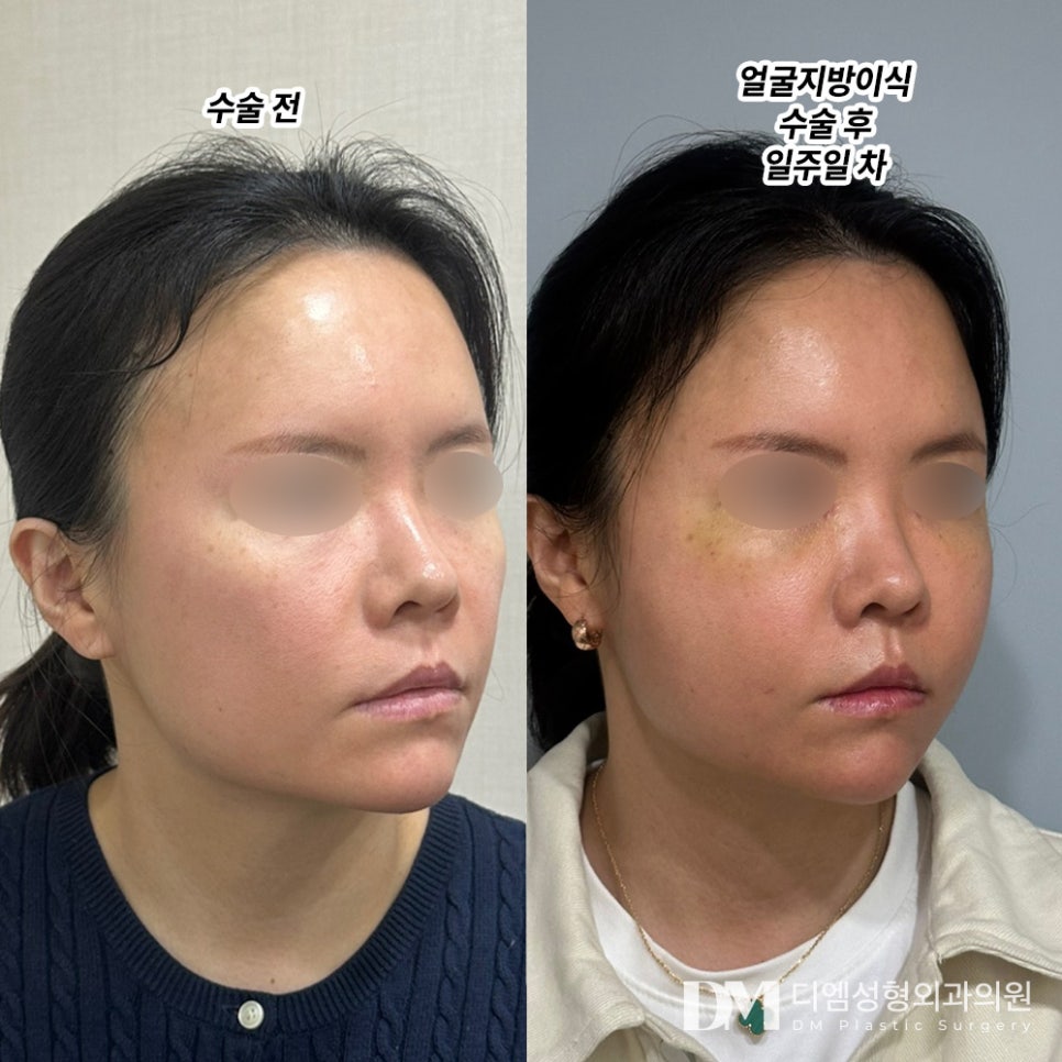얼굴지방이식 후기."부족한 부분 잘 채워진 것 같아 만족 합니다!" 관련 이미지 2