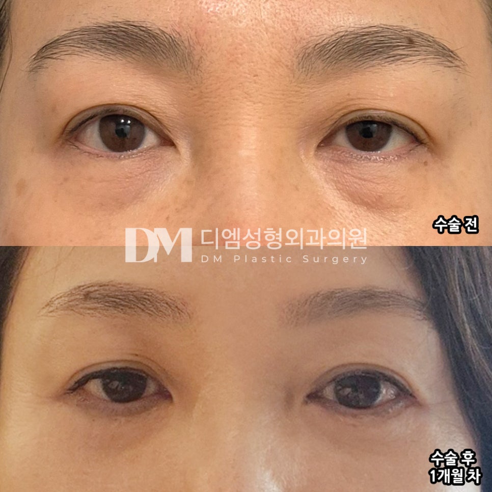 불룩 칙칙한 눈밑이 고민이라면? 관련 이미지 7