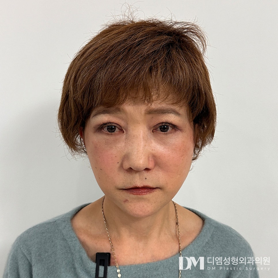 상안검,눈이 자꾸 처져 시야를 가린다면? 관련 이미지 1