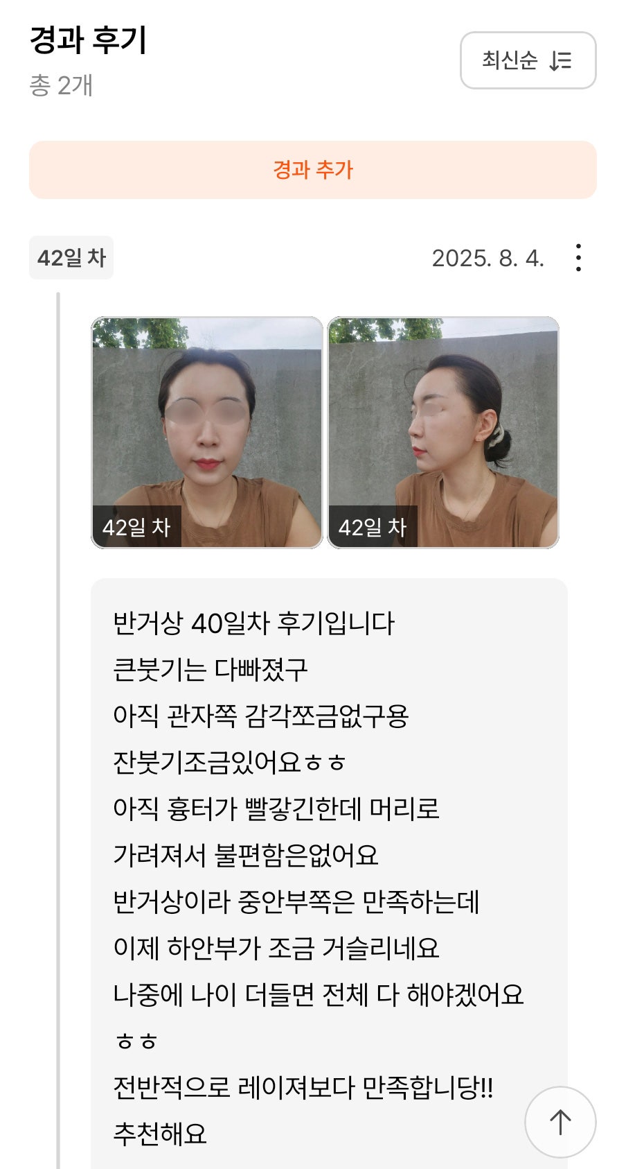 Mini Facelift Review. “More Satisfying Than Laser!! I Recommend It” image 1