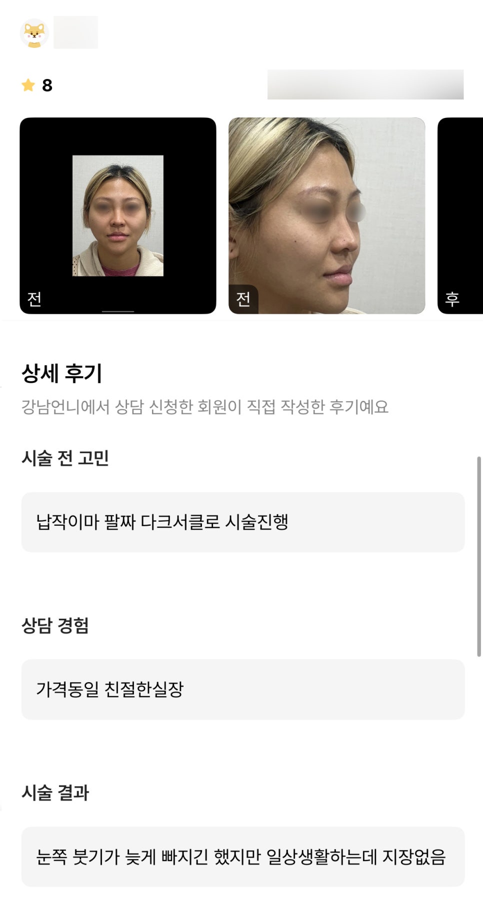 얼굴지방이식 후기."일상생활에 지장도 없고 좋아요!" 관련 이미지 1