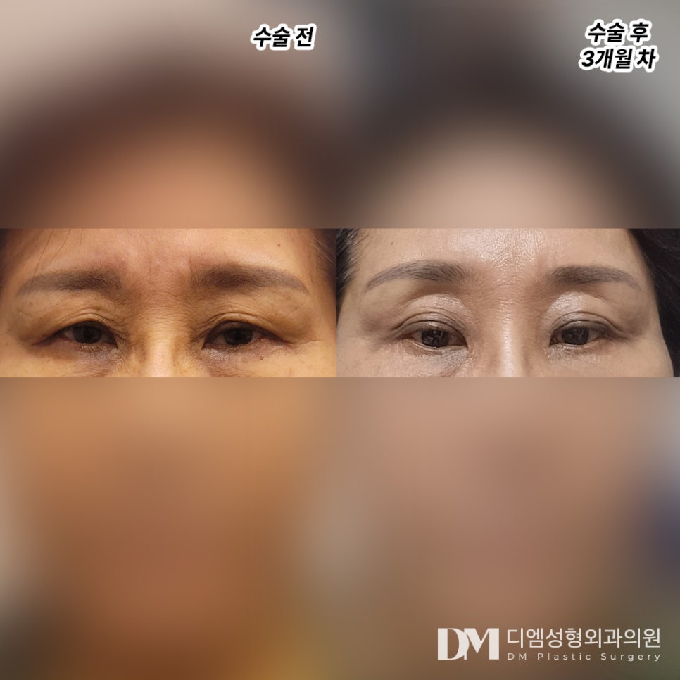 이마거상, 이마처짐으로 인한 불편함 개선하기 관련 이미지 7