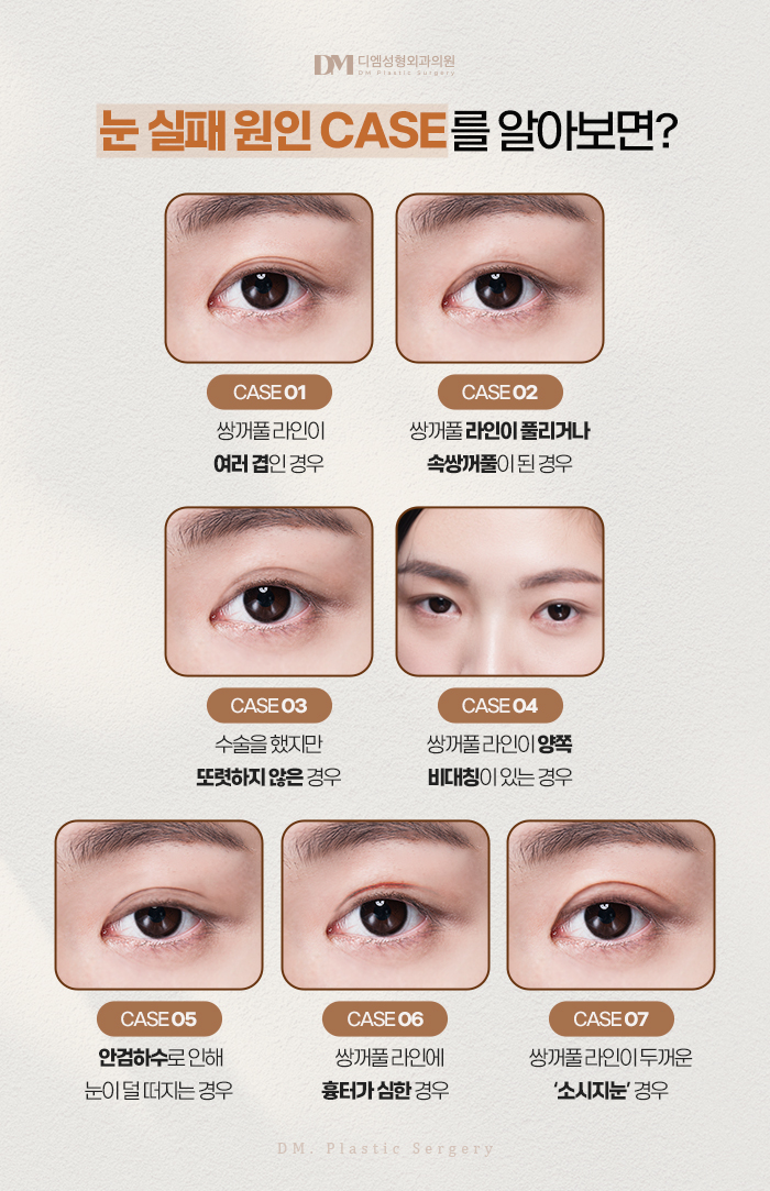 눈재수술, 쌍꺼풀이 풀려 비대칭 눈매가 되었다면? 관련 이미지 4