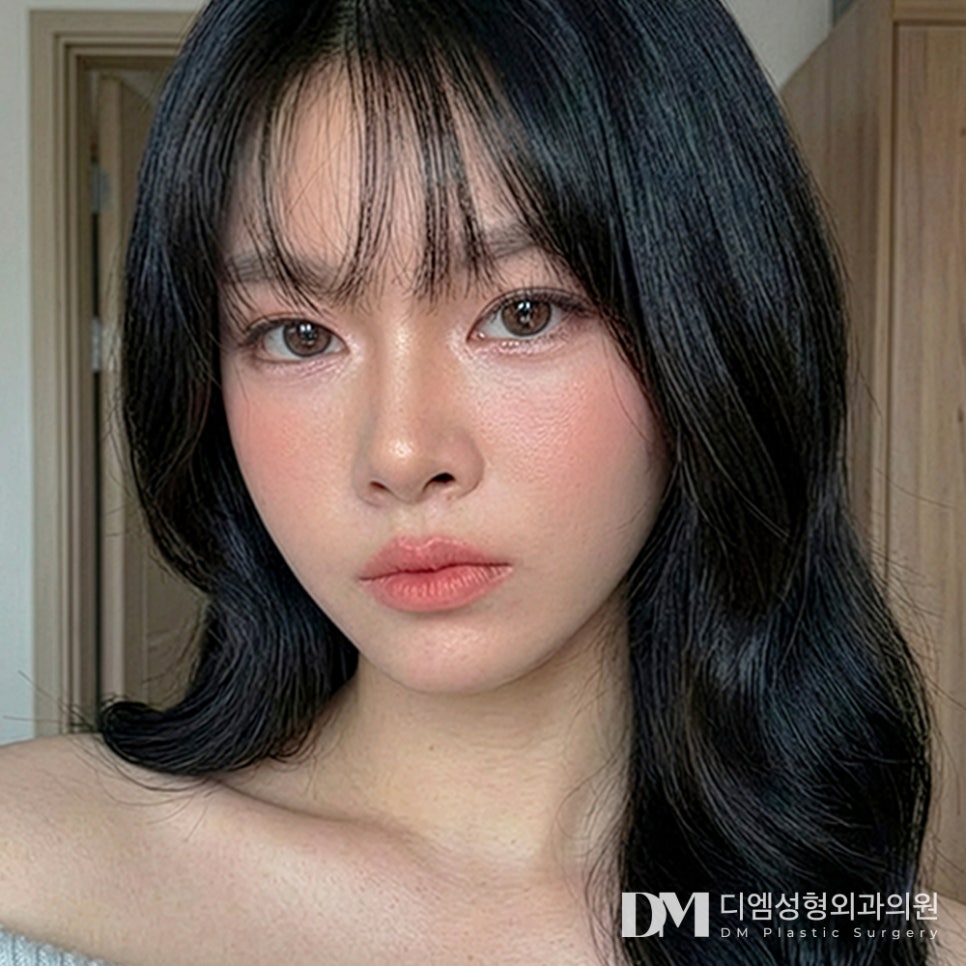 디엠 트임성형 전후사진, 전체적으로 시원한 눈매가 되고 싶다면! 관련 이미지 1