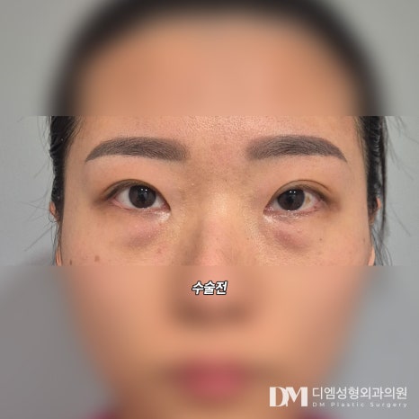 눈성형 후기."시간이 갈수록 자리 잡으니 만족스러워요!" 관련 이미지 2