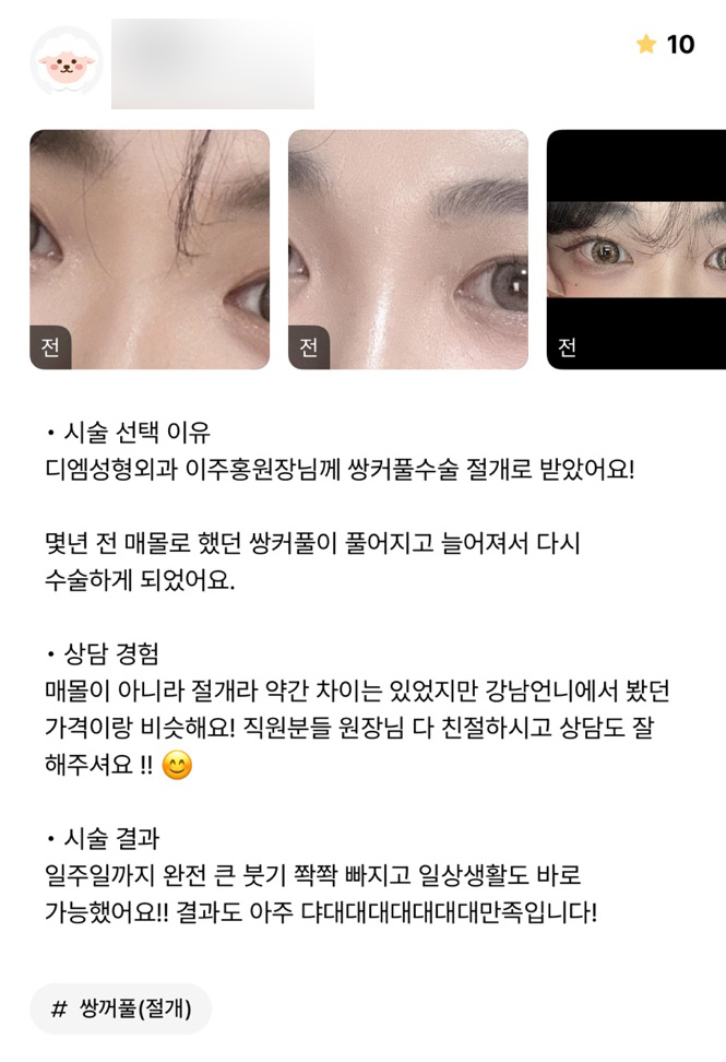 Revision Eyelid Surgery Review. "I was able to return to daily life quickly, and I’m very satisfied with the results!" image 1