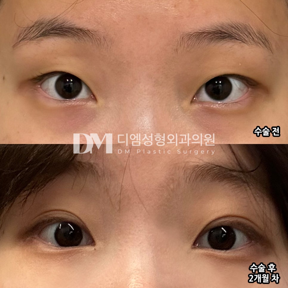 눈성형 후기."이전보다 눈이 훨씬 트이고 예뻐보여서 더 만족스러워요!" 관련 이미지 2
