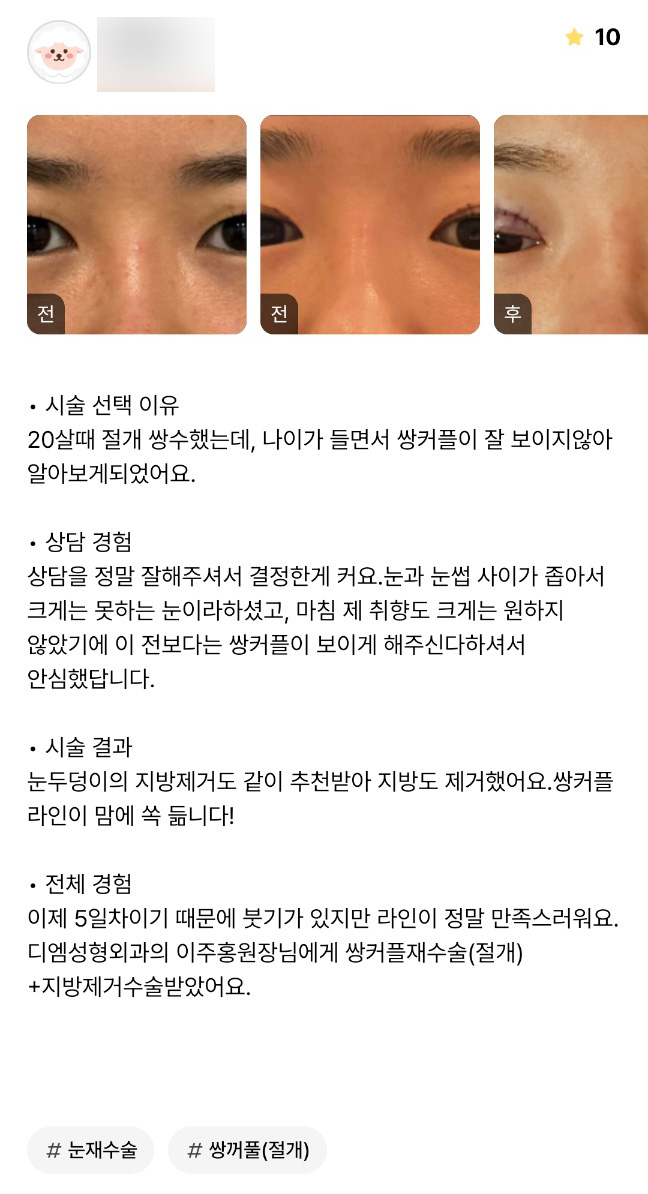 Double-Eyelid Surgery Review: “I Absolutely Love the Double-Eyelid Line!” image 1