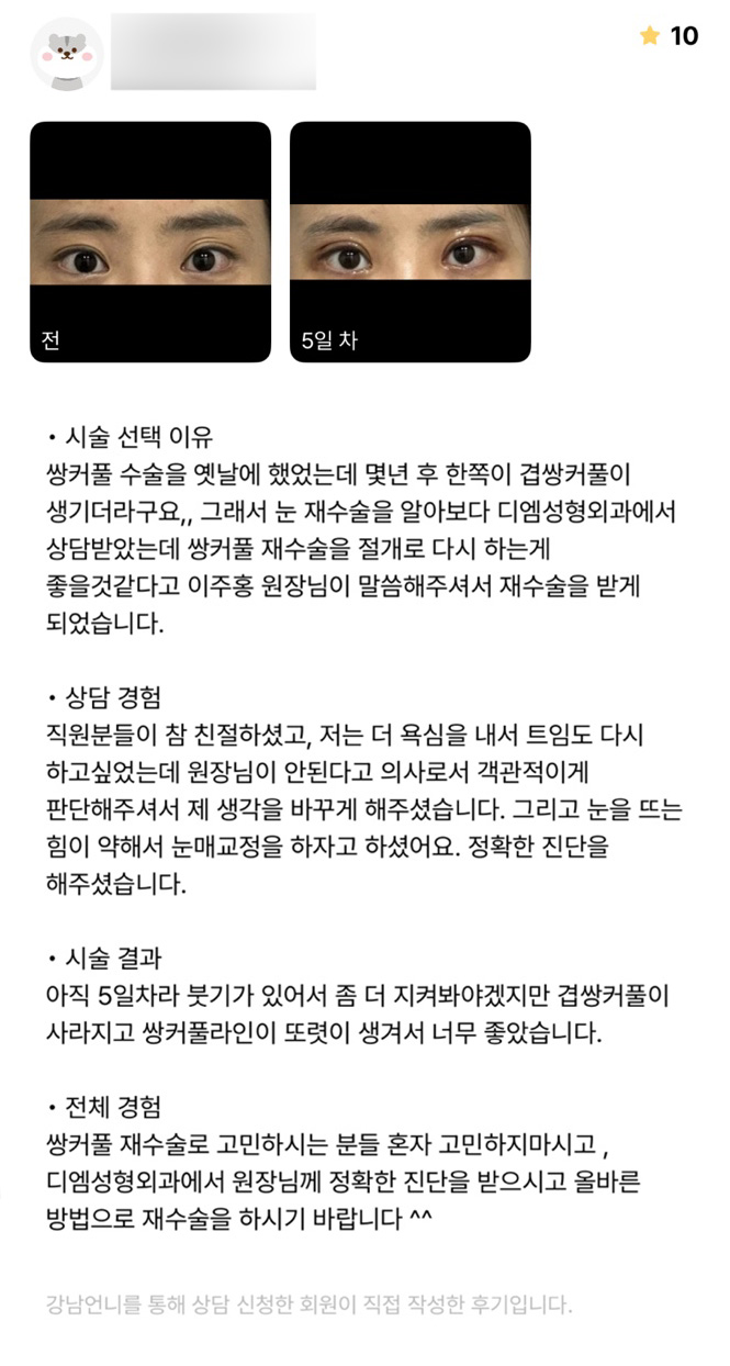 눈재수술 후기."겹주름이 사라지고 쌍꺼풀 라인이 또렷해져서 너무 좋아요!" 관련 이미지 1