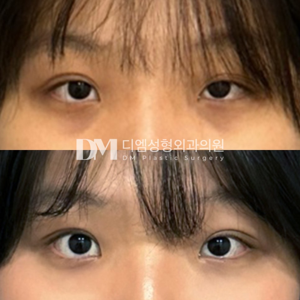 눈성형 후기."너무 자연스러워서 할머니도 못알아보셨어요!" 관련 이미지 2