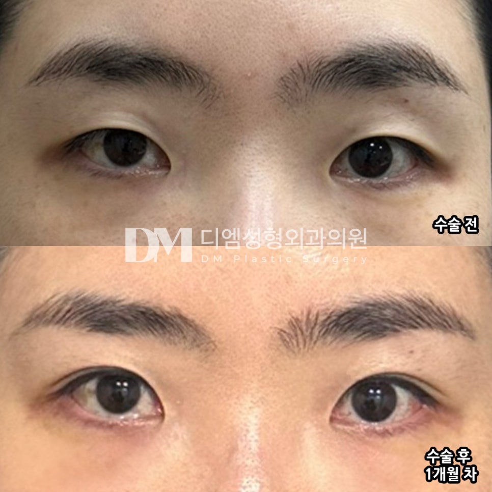 Eye Surgery Review. "I feel that I made the right decision having the surgery—it was almost a waste to have spent so much time hesitating." image 2