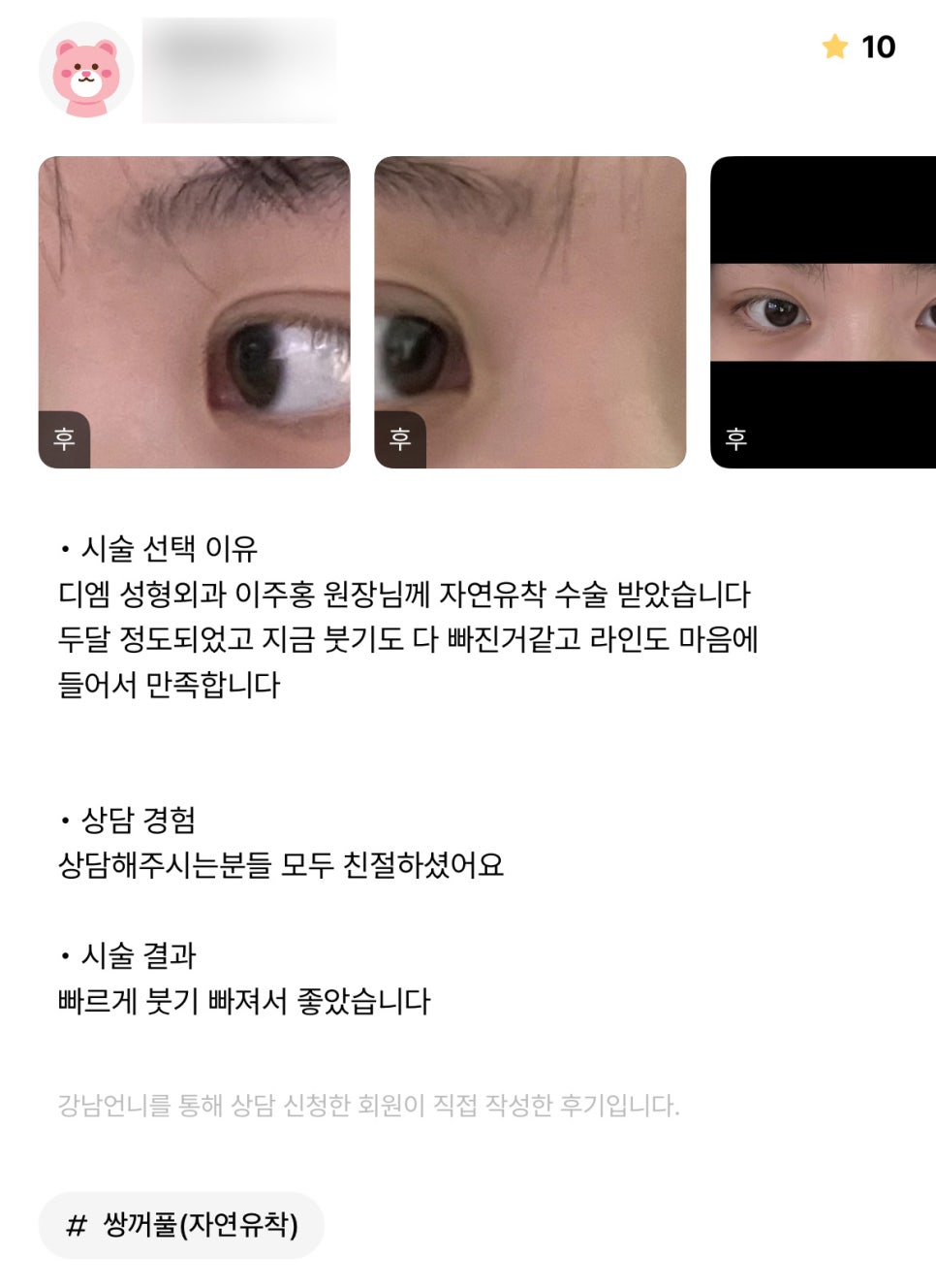 Eyelid Surgery Review. "I’m satisfied because I also like the line!" image 1