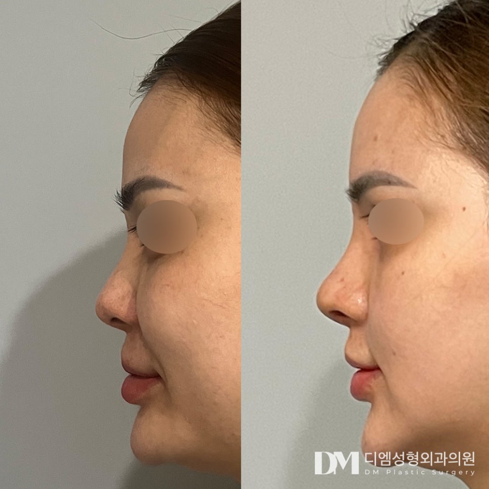 짧은코 성형, 전체적인 얼굴 조화를 고려해 자연스럽게 ! 관련 이미지 8
