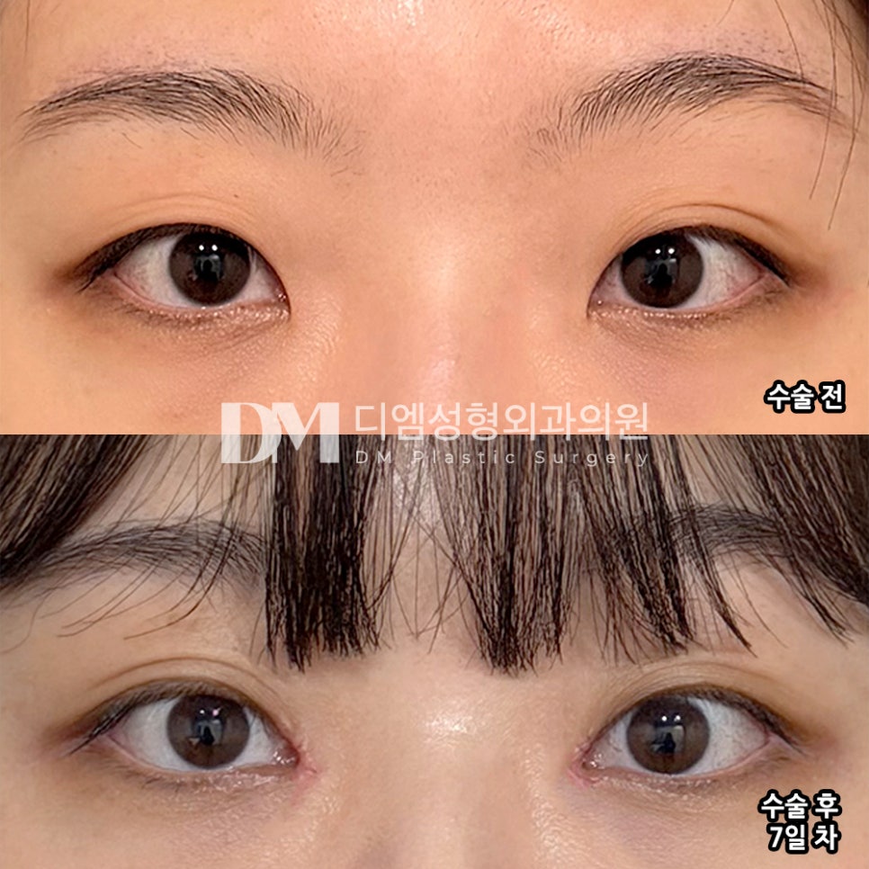 DM Epicanthoplasty Surgery Review, “My eyes look much brighter, and my overall eye shape feels more defined!” image 2