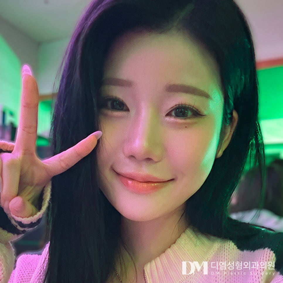 디엠 코성형 전후사진, 낮은 콧대와 짧은코 개선을 원한다면! 관련 이미지 1