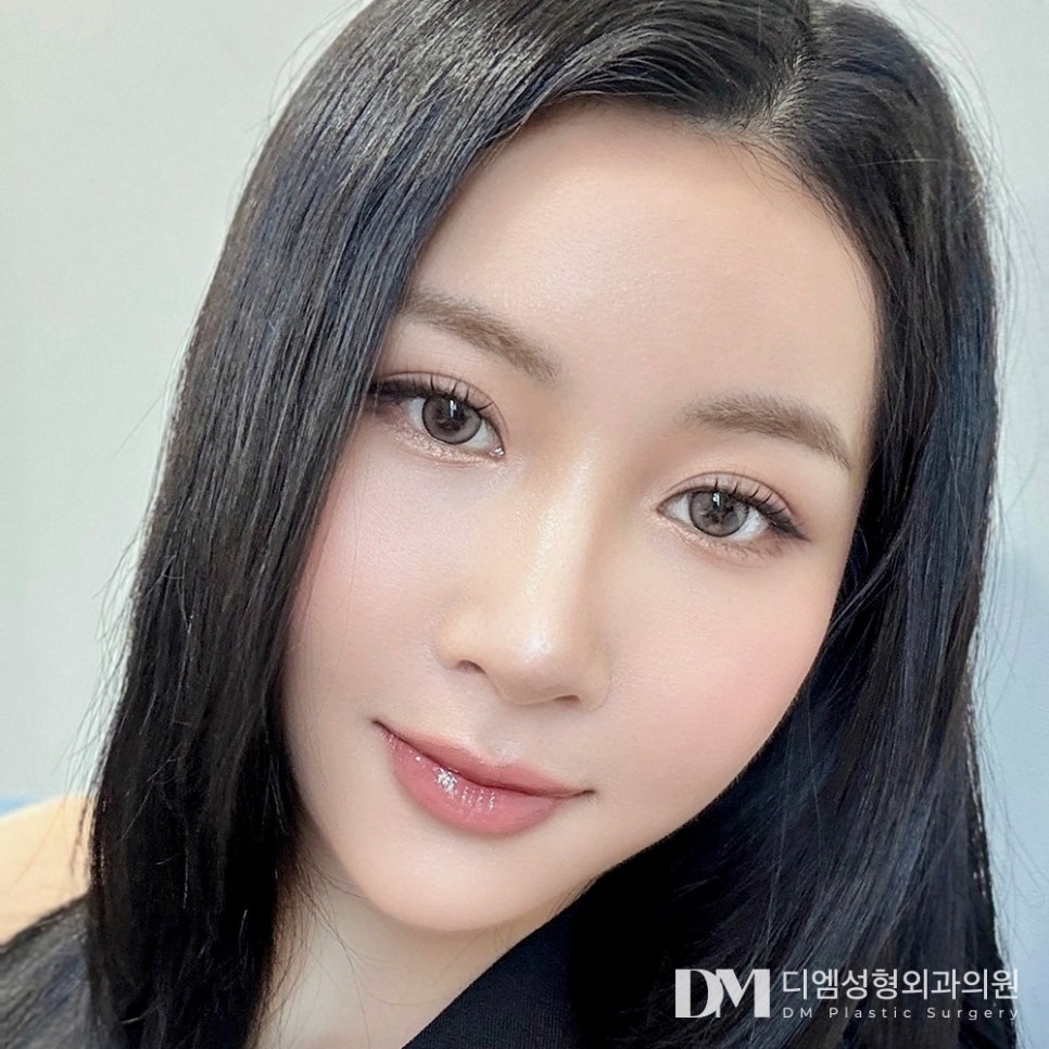 Eyelid Correction, Refreshed and Clear! image 1