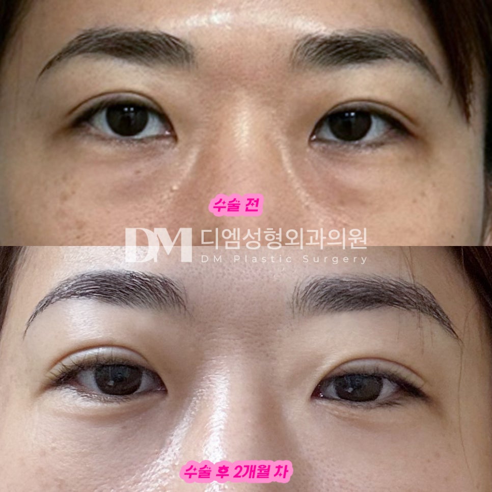 Under-Eye Fat Repositioning Review. "People say I look prettier when I smile and look younger!" image 2