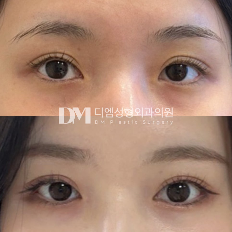 Canthoplasty Review. “Others may not notice, but I feel like there’s a difference only I know about!” image 2
