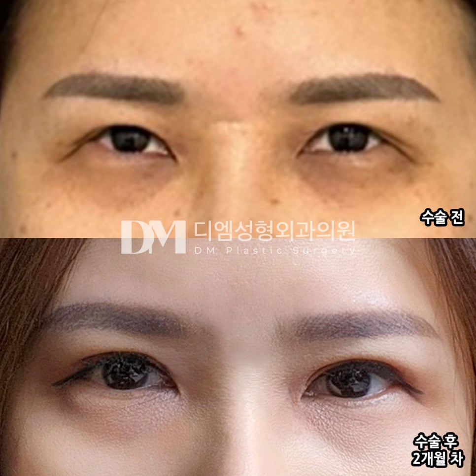 Eye Plastic Surgery Review: “I’m happily going through each day after surgery!” image 2