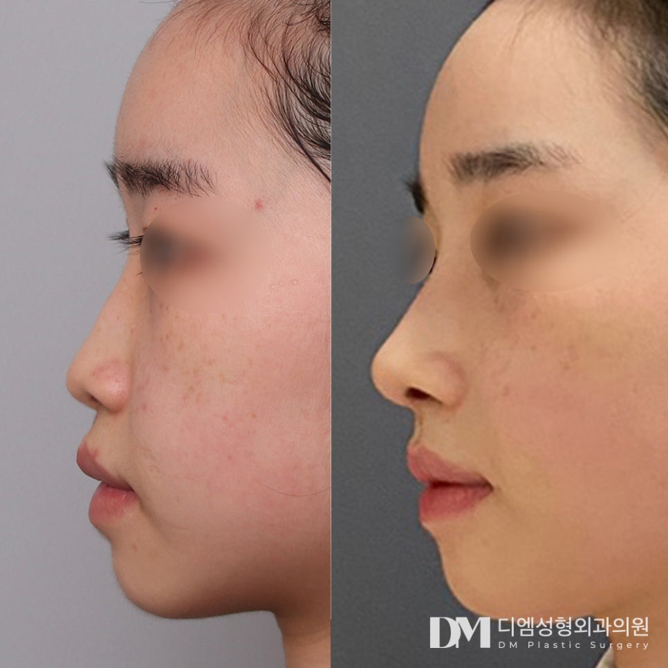 How to Achieve Satisfying Results with Low-Nose Rhinoplasty in a Single Surgery, Without Revision?! image 9