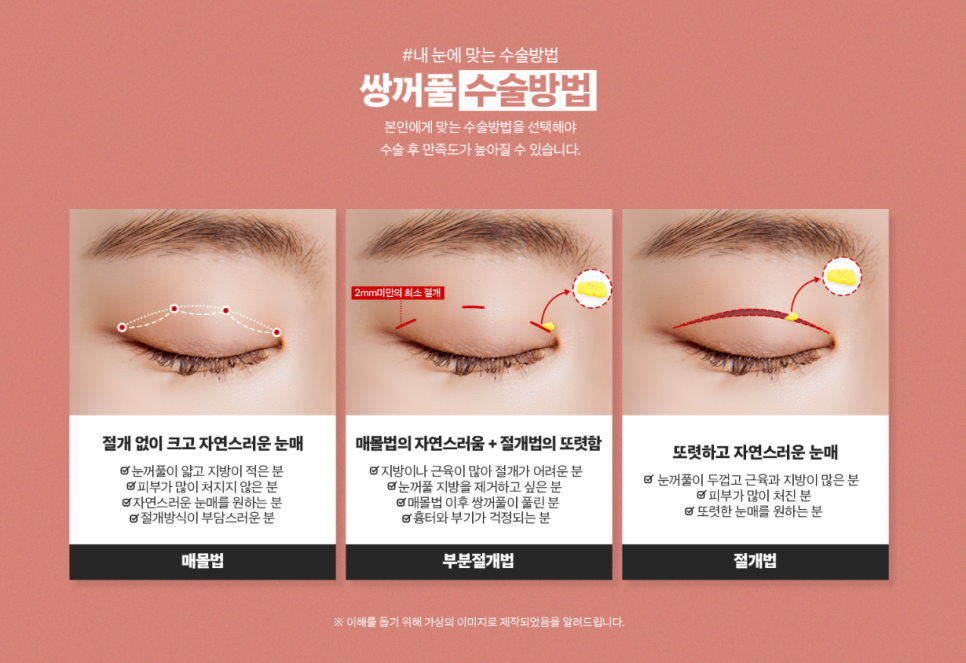 Want to Look Naturally More Beautiful with Double-Eyelid Surgery for the New Year? image 6
