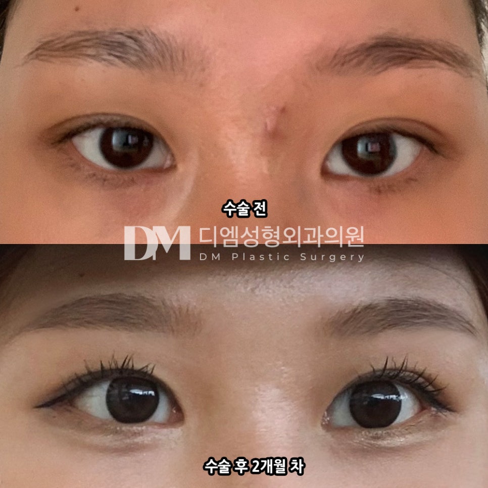 Canthoplasty for the outer and lower corners: improving your look as well as eye size! image 5