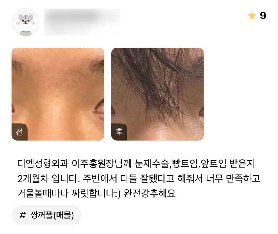 눈성형 후기."너무 만족하고 거울볼때마다 짜릿합니다 :)" 관련 이미지 1