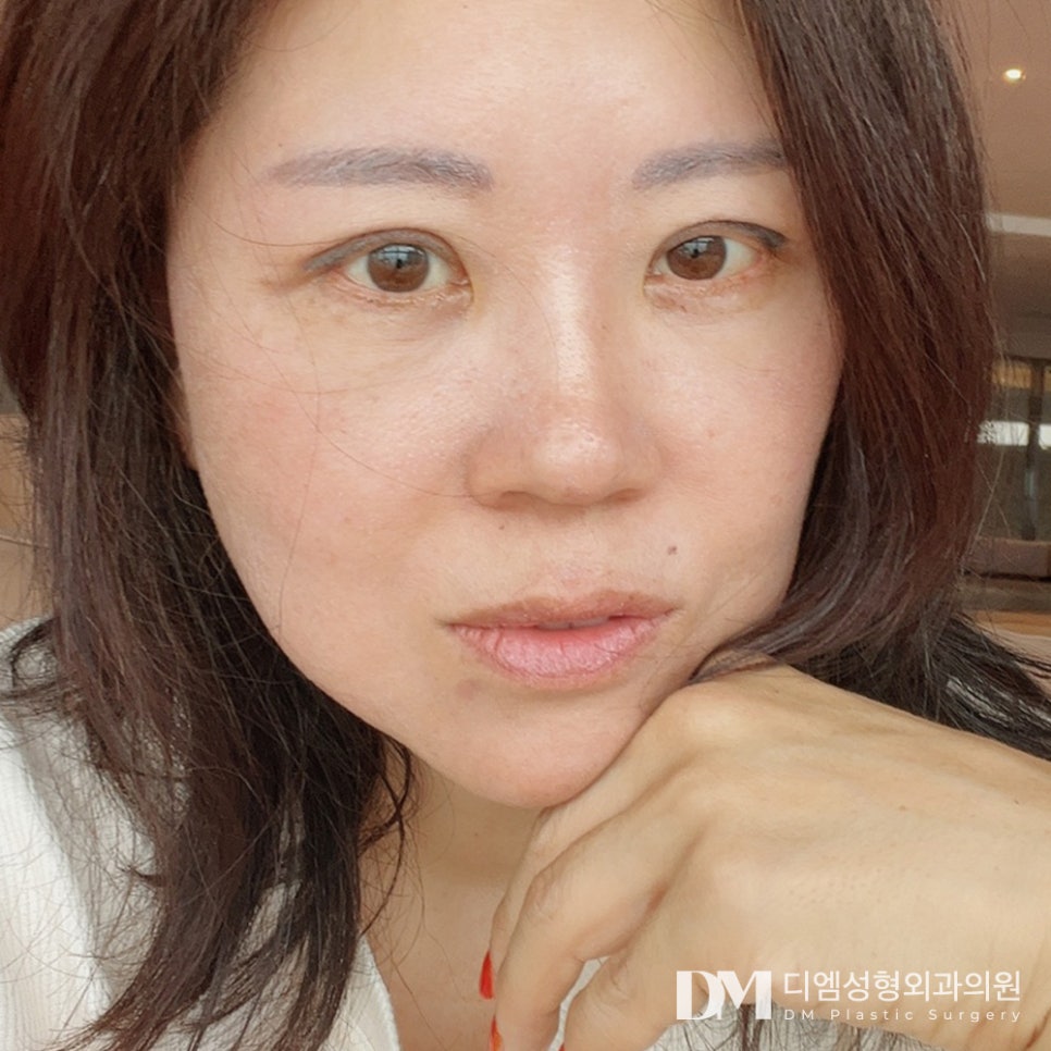 안면거상으로 탄력 잃고 늘어진 피부 되살리기 관련 이미지 1