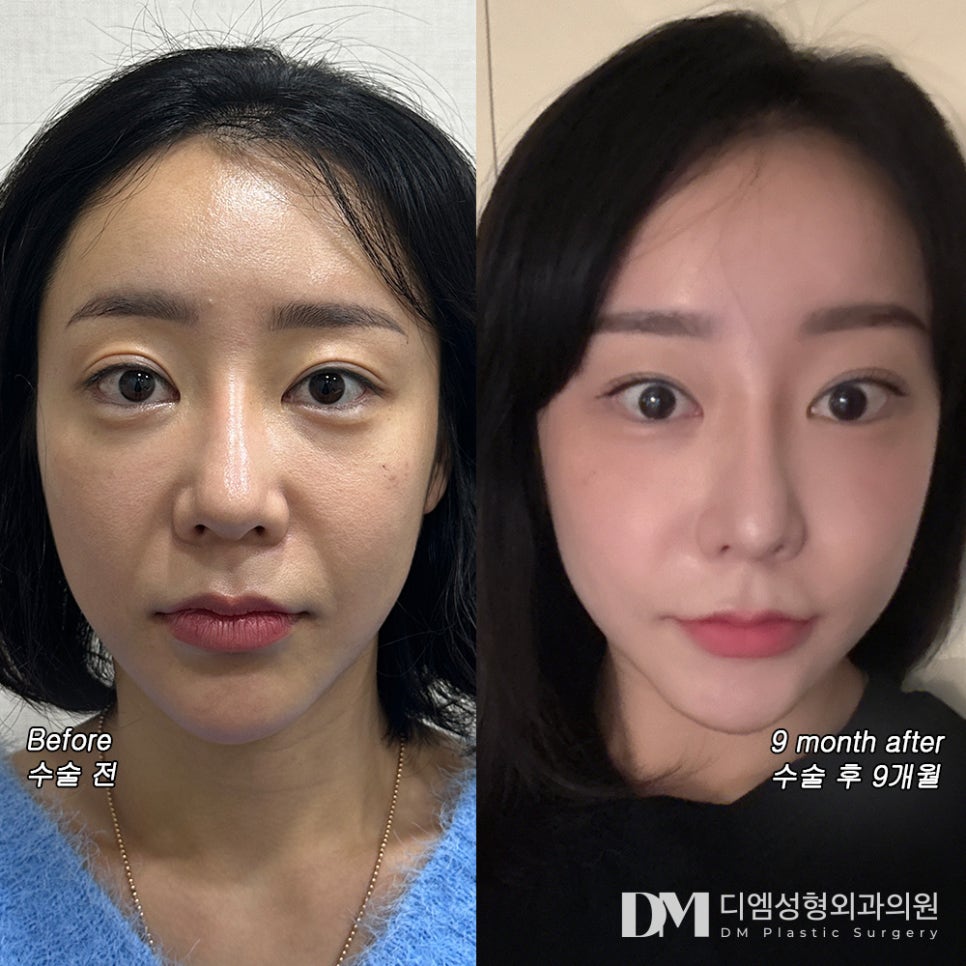 반거상 후기."회복기간이 힘들지 않아 좋았어요!" 관련 이미지 2
