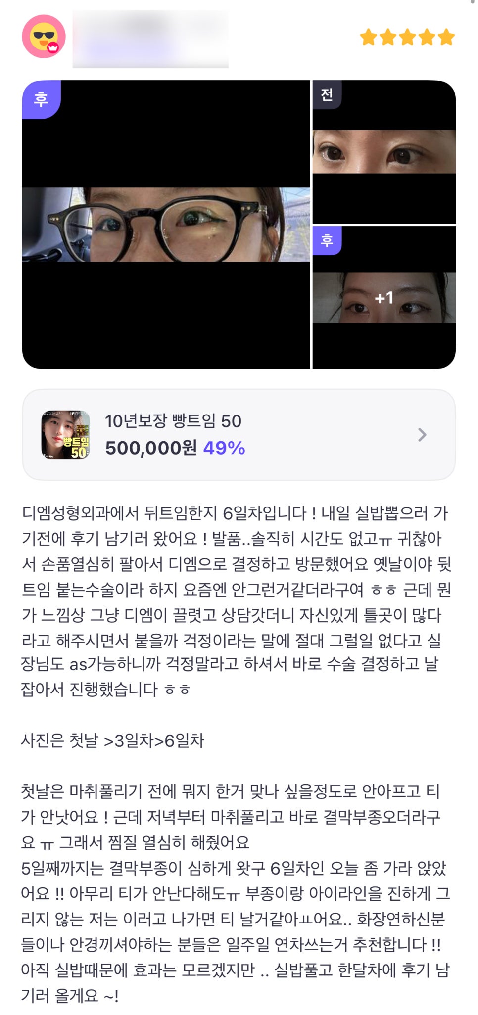 Bangteum Review. “I was told it would be possible to get after-sales service, so I decided to have the surgery!” image 1