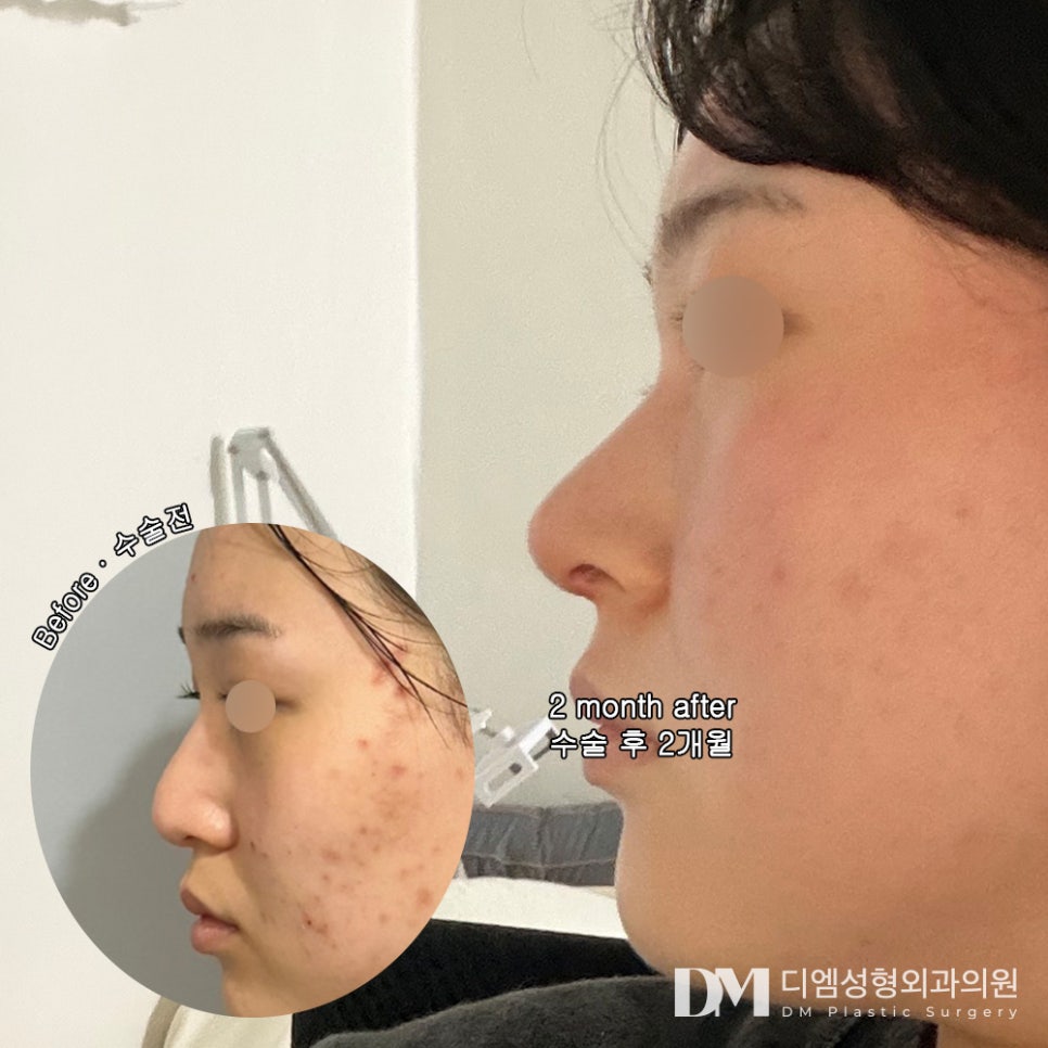 Rhinoplasty Review. "I was so happy that it was not excessive, but natural and clearly effective" image 2