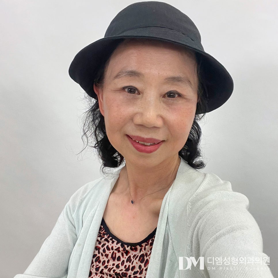 상안검 , 시야확보부터 동안 효과까지 ! 관련 이미지 13