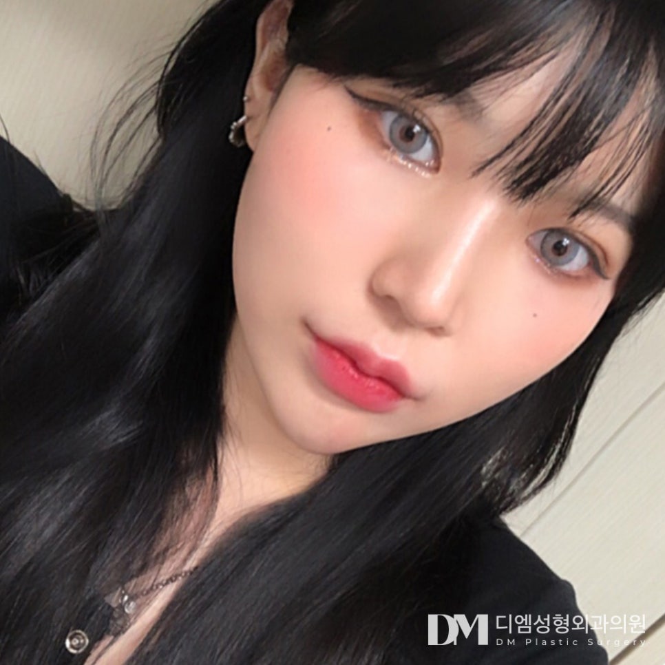 코 끝만 개선 가능할까? 관련 이미지 12